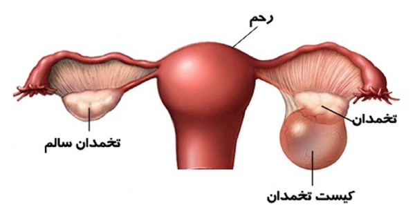 پیچ خوردگی تخمدان